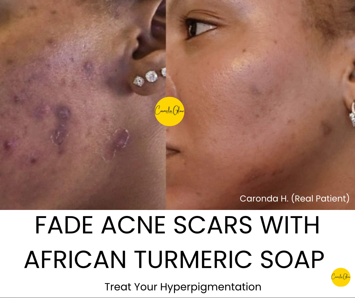 African Turmeric Soap 4.1 oz